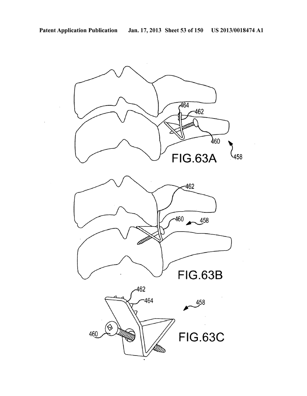 VERTEBRAL JOINT IMPLANTS AND DELIVERY TOOLS - diagram, schematic, and image 54