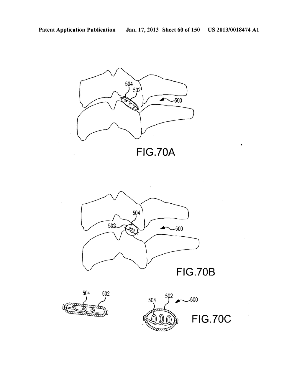 VERTEBRAL JOINT IMPLANTS AND DELIVERY TOOLS - diagram, schematic, and image 61