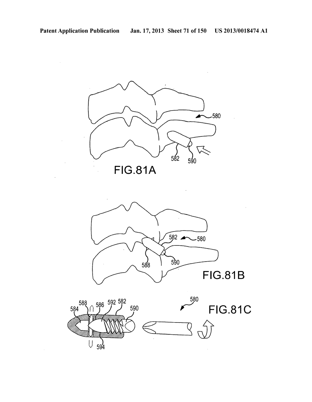 VERTEBRAL JOINT IMPLANTS AND DELIVERY TOOLS - diagram, schematic, and image 72