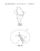 Methods and Devices for Knee Joint Replacement with Anterior Cruciate     Ligament Substitution diagram and image