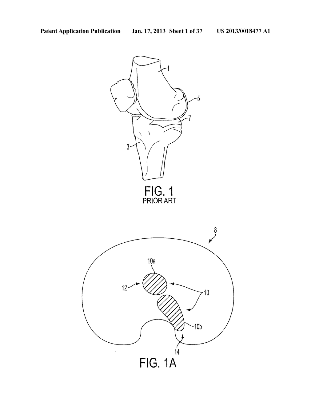 Methods and Devices for Knee Joint Replacement with Anterior Cruciate     Ligament Substitution - diagram, schematic, and image 02