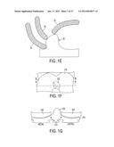 Methods and Devices for Knee Joint Replacement with Anterior Cruciate     Ligament Substitution diagram and image