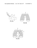 Methods and Devices for Knee Joint Replacement with Anterior Cruciate     Ligament Substitution diagram and image