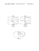 Methods and Devices for Knee Joint Replacement with Anterior Cruciate     Ligament Substitution diagram and image