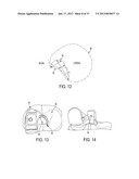 Methods and Devices for Knee Joint Replacement with Anterior Cruciate     Ligament Substitution diagram and image