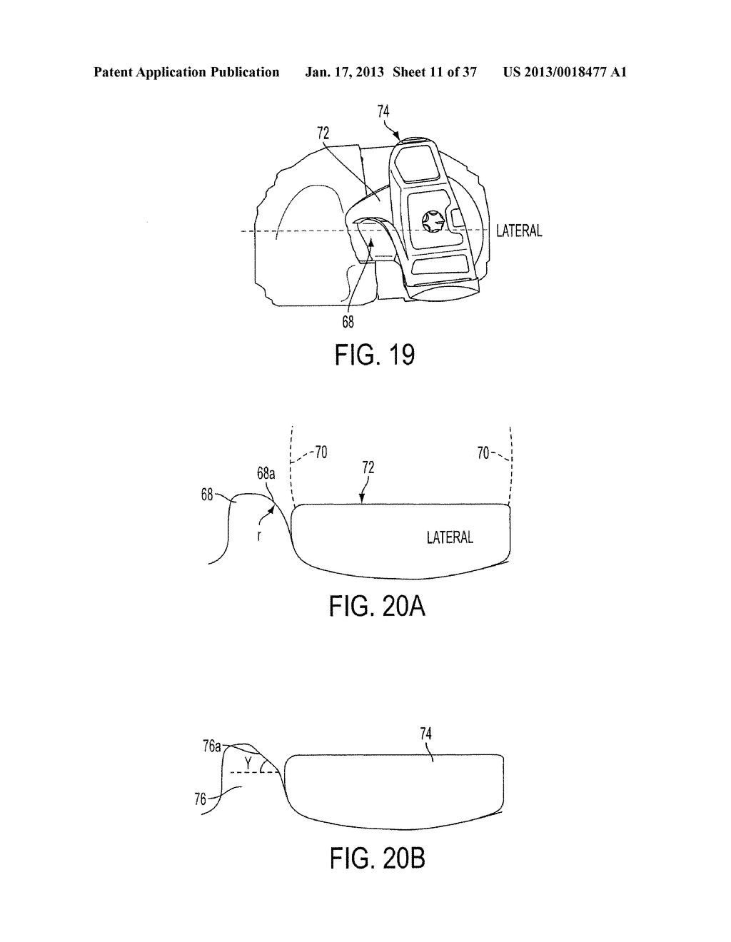 Methods and Devices for Knee Joint Replacement with Anterior Cruciate     Ligament Substitution - diagram, schematic, and image 12