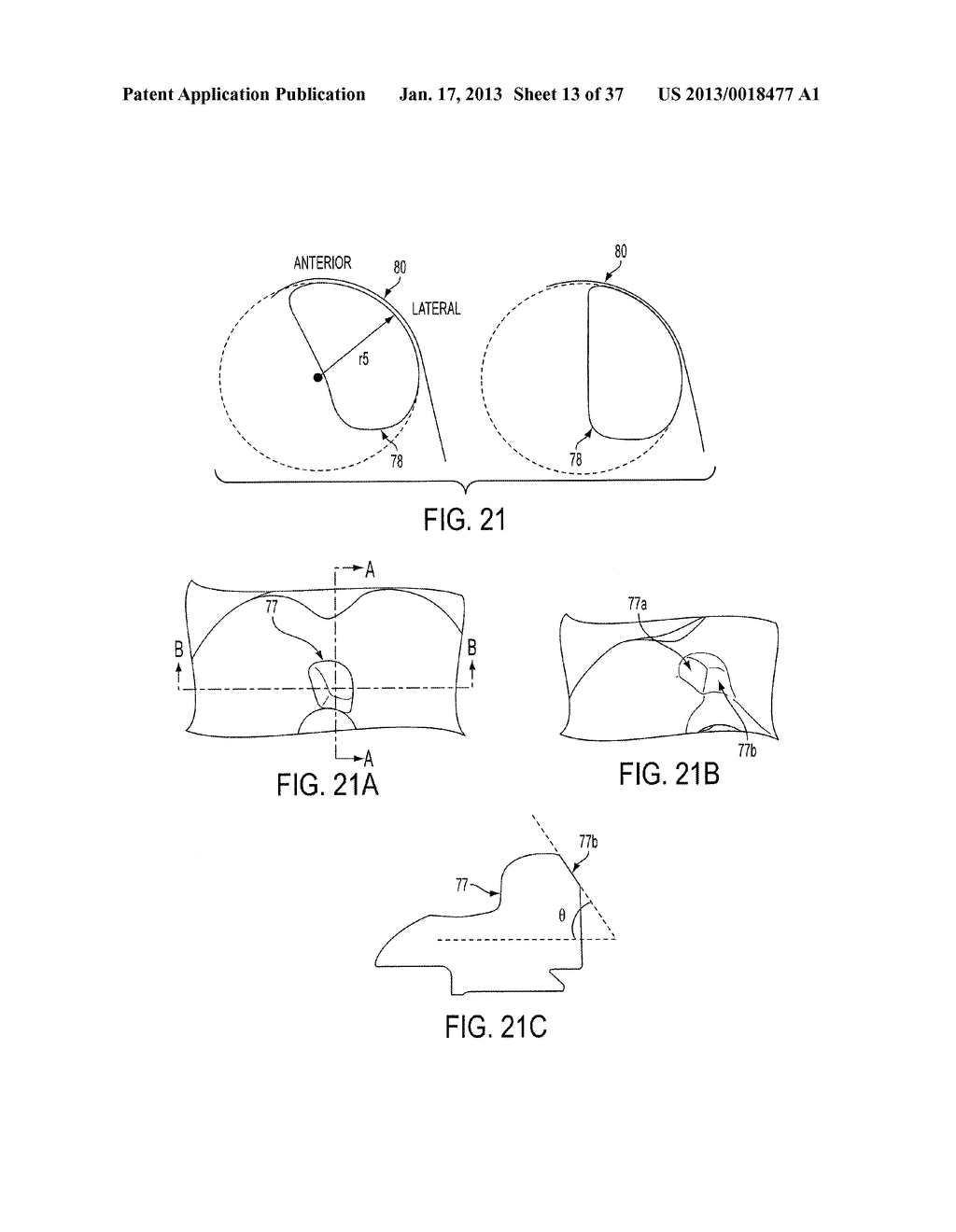 Methods and Devices for Knee Joint Replacement with Anterior Cruciate     Ligament Substitution - diagram, schematic, and image 14