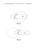 Methods and Devices for Knee Joint Replacement with Anterior Cruciate     Ligament Substitution diagram and image