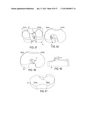 Methods and Devices for Knee Joint Replacement with Anterior Cruciate     Ligament Substitution diagram and image