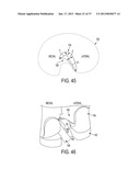 Methods and Devices for Knee Joint Replacement with Anterior Cruciate     Ligament Substitution diagram and image