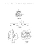 Methods and Devices for Knee Joint Replacement with Anterior Cruciate     Ligament Substitution diagram and image