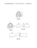 Methods and Devices for Knee Joint Replacement with Anterior Cruciate     Ligament Substitution diagram and image