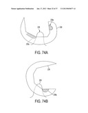 Methods and Devices for Knee Joint Replacement with Anterior Cruciate     Ligament Substitution diagram and image