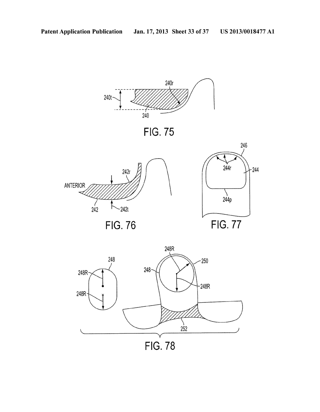 Methods and Devices for Knee Joint Replacement with Anterior Cruciate     Ligament Substitution - diagram, schematic, and image 34