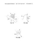 Methods and Devices for Knee Joint Replacement with Anterior Cruciate     Ligament Substitution diagram and image