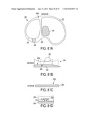 Methods and Devices for Knee Joint Replacement with Anterior Cruciate     Ligament Substitution diagram and image