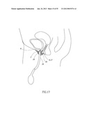 GEL-BASED SEALS AND FIXATION DEVICES AND ASSOCIATED SYSTEMS AND METHODS diagram and image