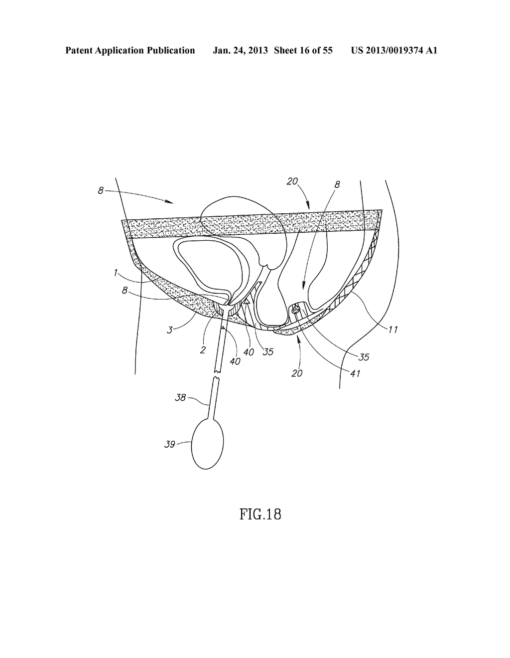 GEL-BASED SEALS AND FIXATION DEVICES AND ASSOCIATED SYSTEMS AND METHODS - diagram, schematic, and image 17