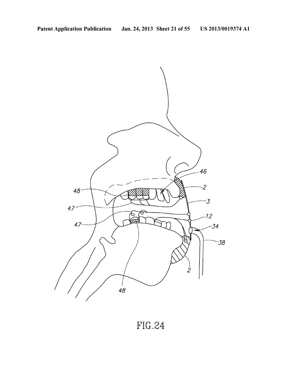 GEL-BASED SEALS AND FIXATION DEVICES AND ASSOCIATED SYSTEMS AND METHODS - diagram, schematic, and image 22