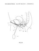 GEL-BASED SEALS AND FIXATION DEVICES AND ASSOCIATED SYSTEMS AND METHODS diagram and image