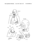 METHODS, SYSTEMS AND DEVICES FOR IMPROVING VENTILATION IN A LUNG AREA diagram and image