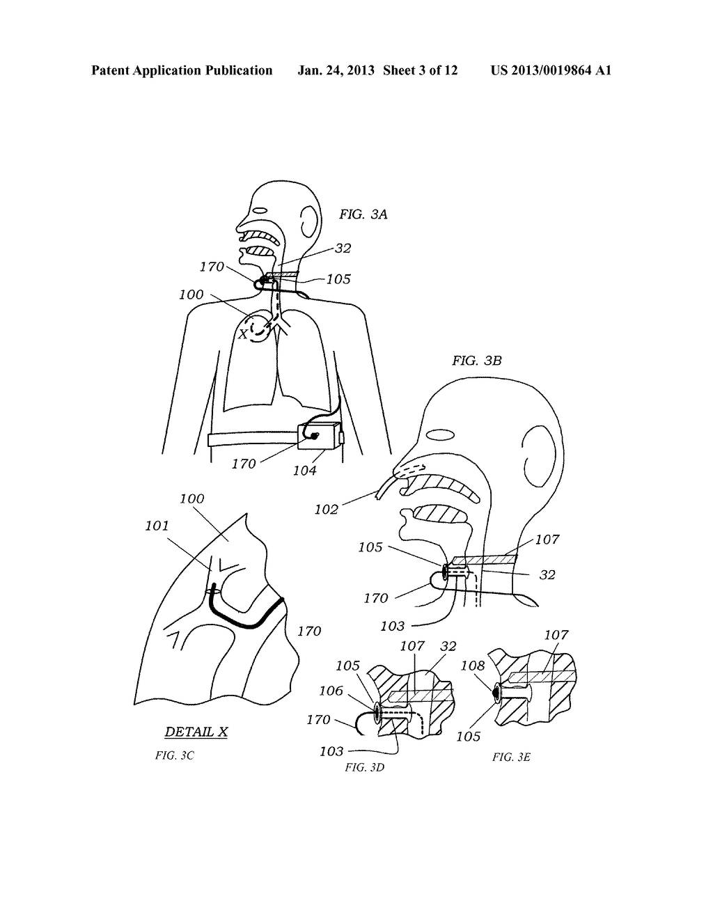 METHODS, SYSTEMS AND DEVICES FOR IMPROVING VENTILATION IN A LUNG AREA - diagram, schematic, and image 04