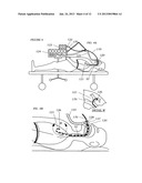 METHODS, SYSTEMS AND DEVICES FOR IMPROVING VENTILATION IN A LUNG AREA diagram and image