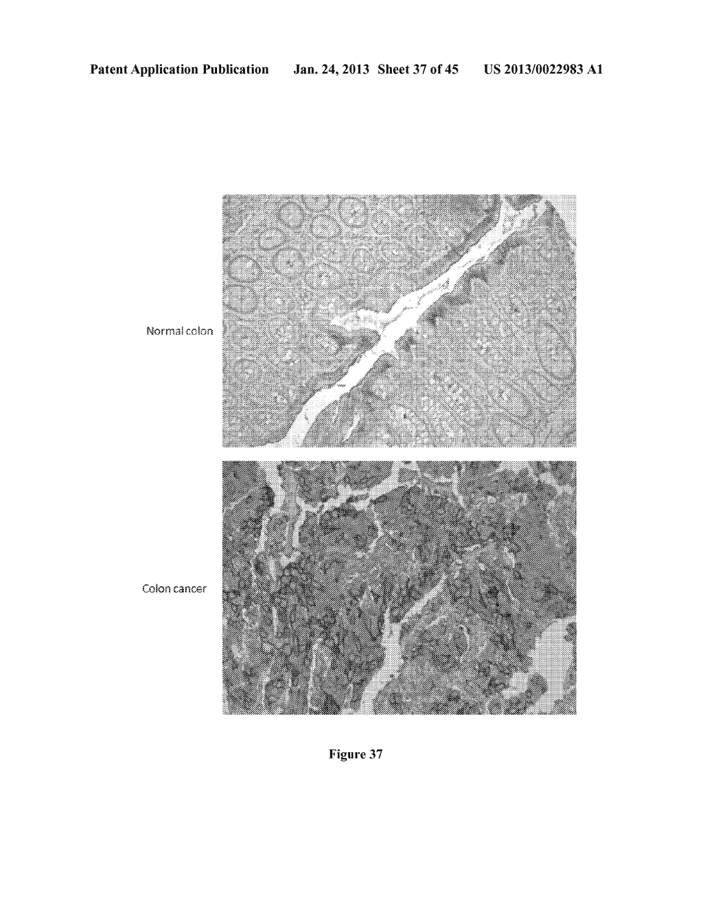 Colon and Rectal Tumor Markers and Methods of Use Thereof - diagram, schematic, and image 38