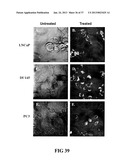 DETECTING PAX2 FOR THE DIAGNOSIS OF BREAST CANCER diagram and image