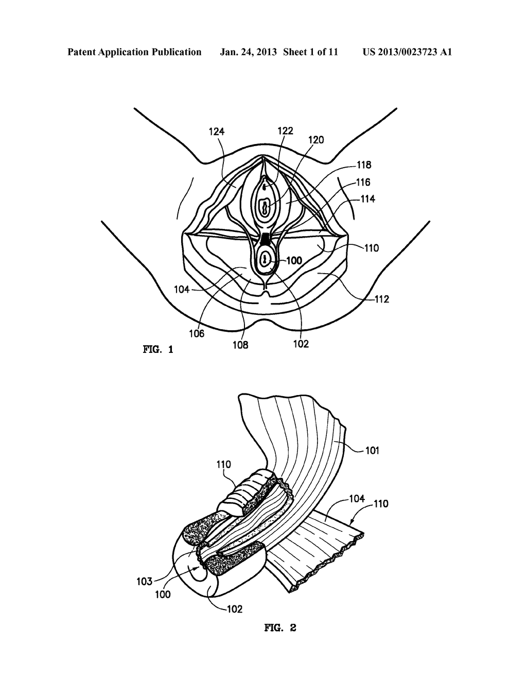 SYSTEMS AND METHODS FOR TREATMENT OF FECAL INCONTINENCE - diagram, schematic, and image 02