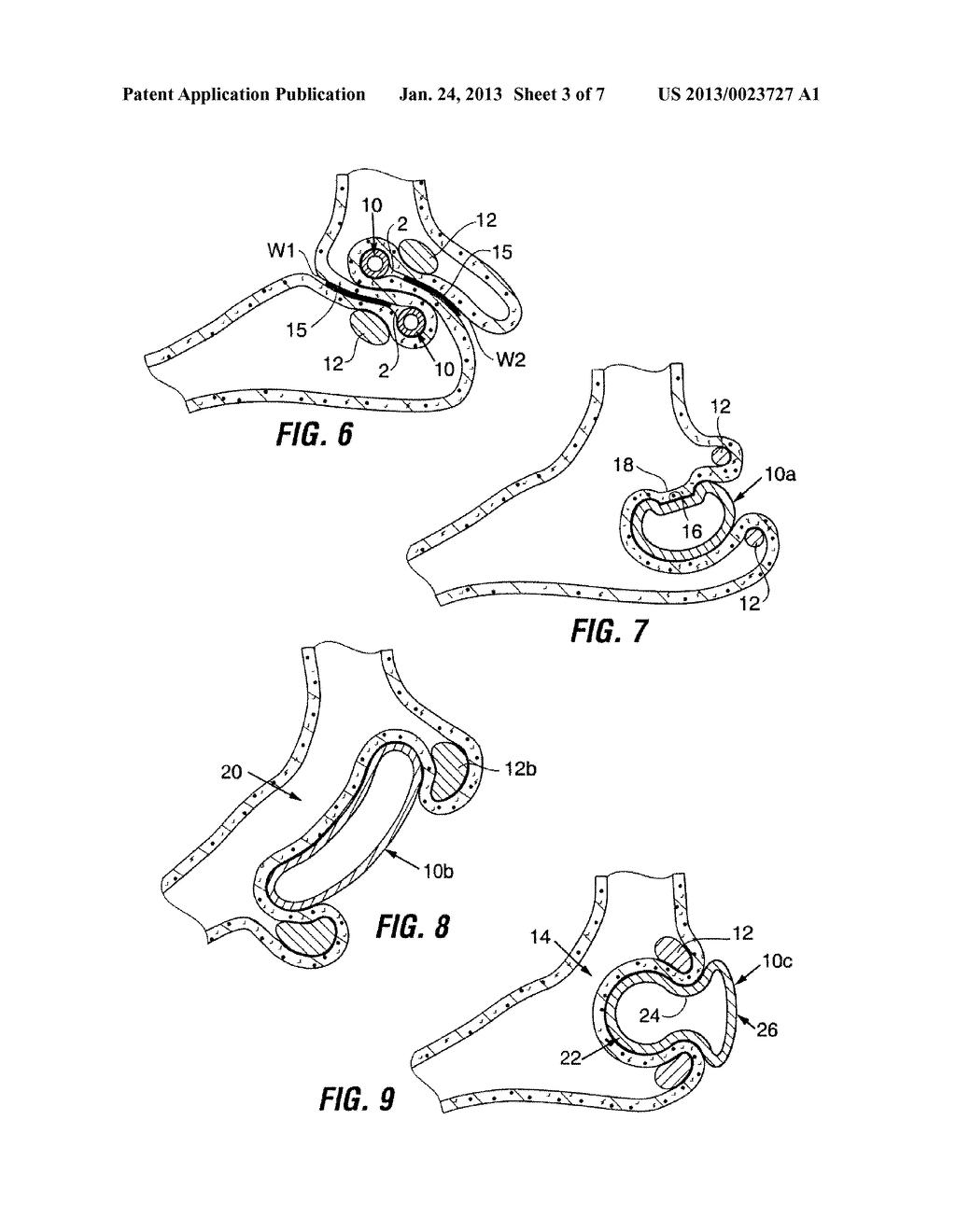 RESTRICTIVE AND/OR OBSTRUCTIVE IMPLANT FOR INDUCING WEIGHT LOSS - diagram, schematic, and image 04