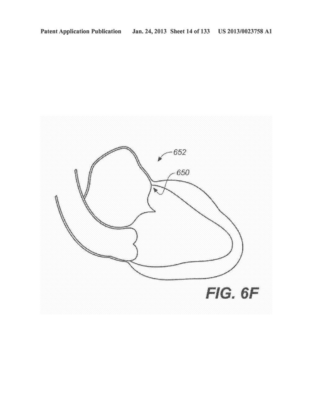 DIAGNOSTIC CATHETERS, GUIDE CATHETERS, VISUALIZATION DEVICES AND CHORD     MANIPULATION DEVICES, AND RELATED KITS AND METHODS - diagram, schematic, and image 15