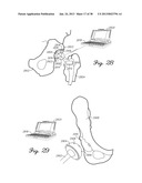 DISTRACTOR HAVING A CAPACITIVE SENSOR ARRAY FOR MEASURING A FORCE,     PRESSURE, OR LOAD APPLIED BY THE MUSCULAR-SKELETAL SYSTEM AND METHOD     THEREFOR diagram and image