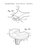 DISTRACTOR HAVING A CAPACITIVE SENSOR ARRAY FOR MEASURING A FORCE,     PRESSURE, OR LOAD APPLIED BY THE MUSCULAR-SKELETAL SYSTEM AND METHOD     THEREFOR diagram and image