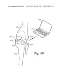 DISTRACTOR HAVING A CAPACITIVE SENSOR ARRAY FOR MEASURING A FORCE,     PRESSURE, OR LOAD APPLIED BY THE MUSCULAR-SKELETAL SYSTEM AND METHOD     THEREFOR diagram and image