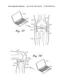 DISTRACTOR HAVING A CAPACITIVE SENSOR ARRAY FOR MEASURING A FORCE,     PRESSURE, OR LOAD APPLIED BY THE MUSCULAR-SKELETAL SYSTEM AND METHOD     THEREFOR diagram and image