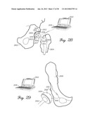 DISTRACTOR HAVING AN INTERNAL LOAD MEASURMENT SYSTEM FOR THE     MUSCULAR-SKELETAL SYSTEM AND METHOD THEREFOR diagram and image