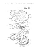 DISTRACTOR HAVING AN INTERNAL LOAD MEASURMENT SYSTEM FOR THE     MUSCULAR-SKELETAL SYSTEM AND METHOD THEREFOR diagram and image