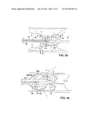 APPARATUS AND METHOD FOR DESTRUCTION OF VASCULAR THROMBUS diagram and image