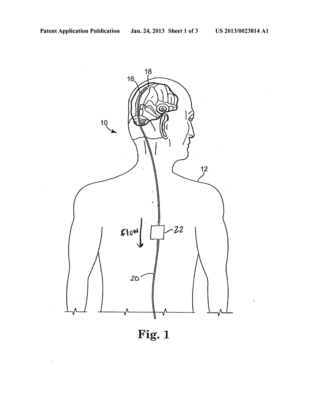 METHOD OF USING A SYSTEM FOR DRAINING CEREBRAL SPINAL FLUID - diagram, schematic, and image 02