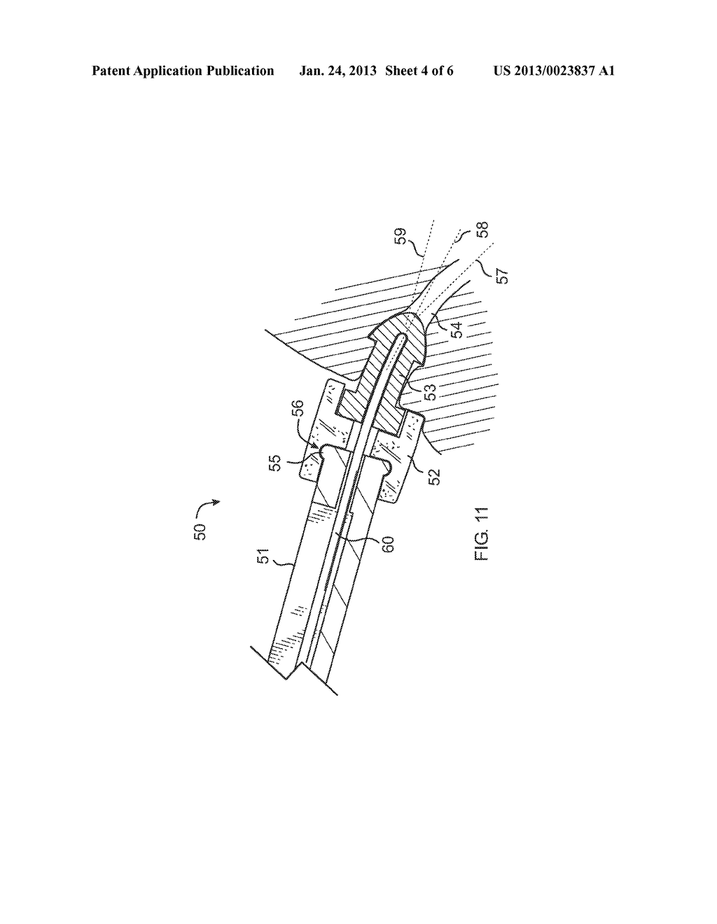 Punctal plug inserter and method - diagram, schematic, and image 05