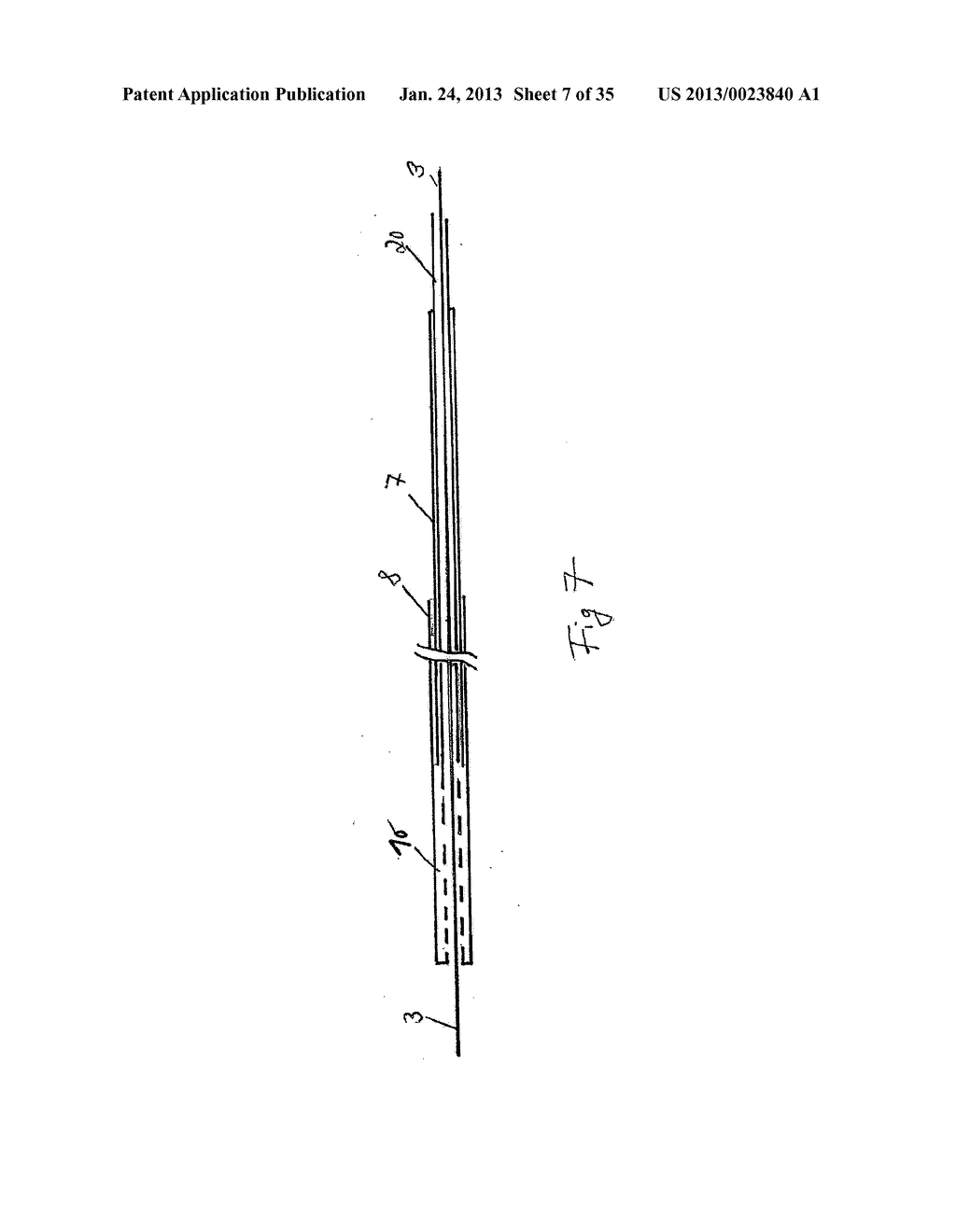 Vacuum Sponge Drainage - diagram, schematic, and image 08