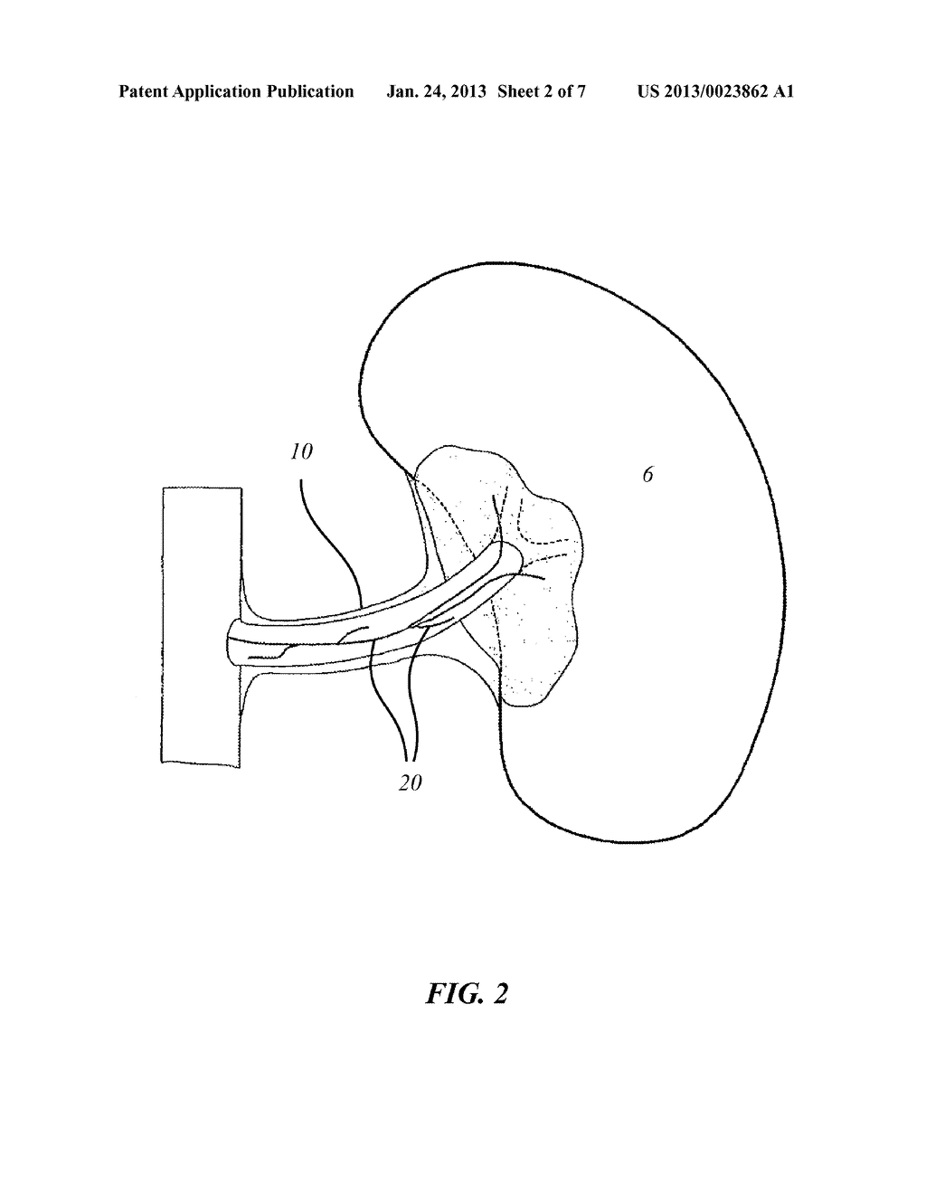 IMAGE-GUIDED RENAL NERVE ABLATION - diagram, schematic, and image 03