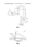 METHOD AND APPARATUS FOR PATTERNED PLASMA-MEDIATED LASER TREPHINATION OF     THE LENS CAPSULE AND THREE DIMENSIONAL PHACO-SEGMENTATION diagram and image