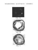 Imaging and Eccentric Atherosclerotic Material Laser Remodeling and/or     Ablation Catheter diagram and image