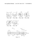 Imaging and Eccentric Atherosclerotic Material Laser Remodeling and/or     Ablation Catheter diagram and image