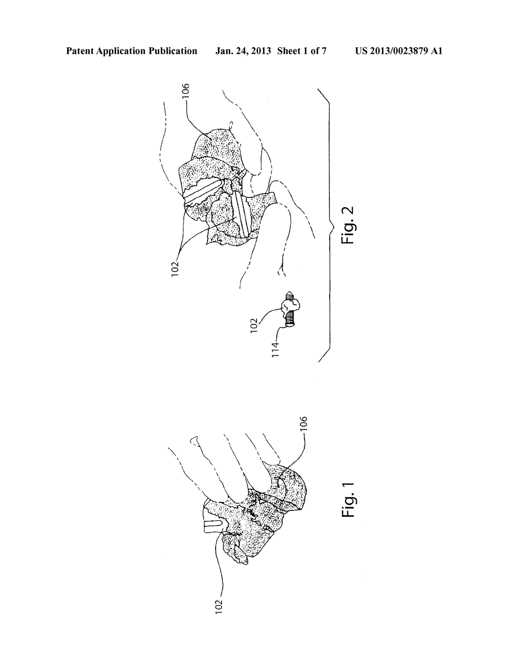 METHOD FOR AUGMENTING, REDUCING, AND REPAIRING BONE WITH THERMOPLASTIC     MATERIALS (AS AMENDED) - diagram, schematic, and image 02