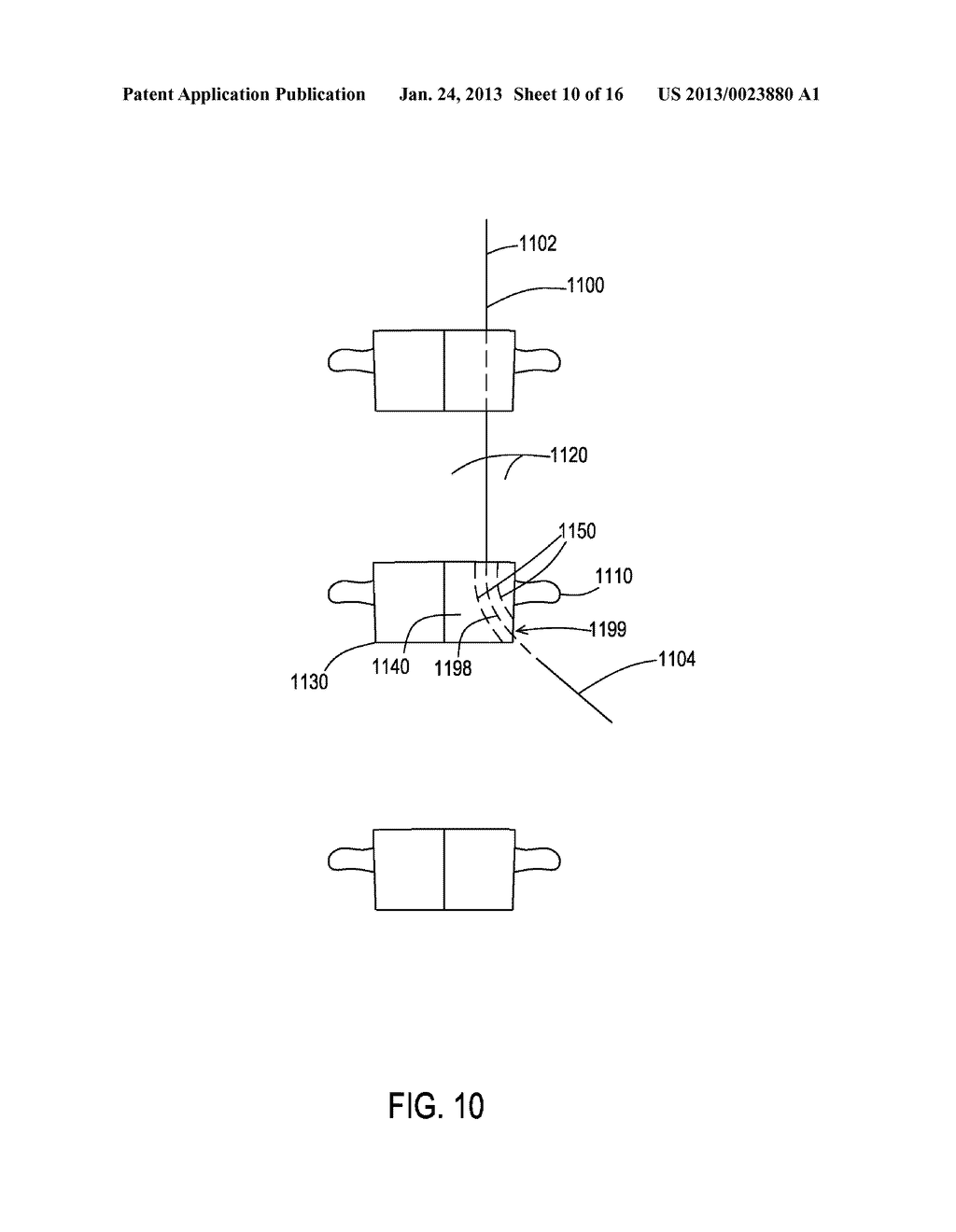 Percutaneous Methods For Spinal Stenosis and Foraminal Stenosis - diagram, schematic, and image 11