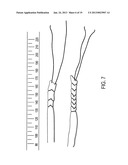 SUTURE TENSIONING DEVICE diagram and image