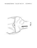 SUTURE TENSIONING DEVICE diagram and image